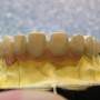 debreceni fogászat, dentland, fog implant, fogászat debrecen, foggerinc helyreállítás, fogpótlás, implantáció