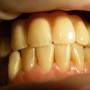 debreceni fogászat, dentland, fog implant, fogászat debrecen, foggerinc helyreállítás, fogpótlás, implantáció