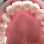 debreceni fogászat, dentland, fog implant, fogászat debrecen, foggerinc helyreállítás, fogpótlás, implantáció