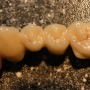 debreceni fogászat, dentland, fog implant, fogászat debrecen, foggerinc helyreállítás, fogpótlás, implantáció
