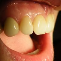 azonnali fogpótlás, azonnali implantáció, debreceni fogászat, dentland, fog implantátum, fogászat debrecen, fogászati implantátum, fogbeültetés, fogpótlás, implantátum