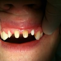 azonnali fogpótlás, azonnali implantáció, debreceni fogászat, dentland, fog implantátum, fogászat debrecen, fogászati implantátum, fogbeültetés, fogpótlás, implantátum